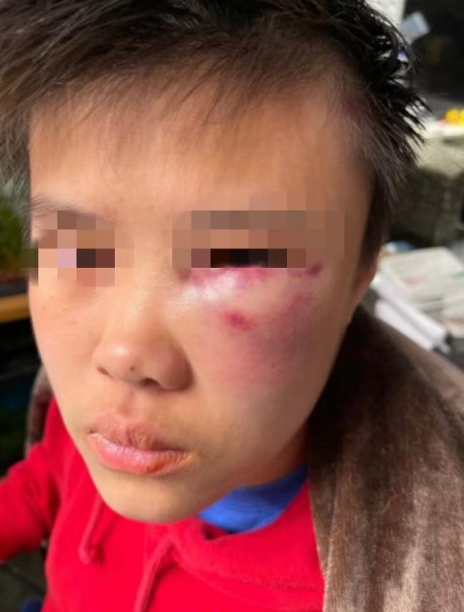 震惊!列治文14岁华裔女生,在学校被同学殴打致昏迷!下手太狠了… 震惊!列治文14岁华裔女生,在学校被同学殴打致昏迷!下手太狠了…