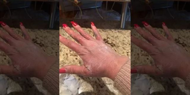 小心!加国妹子被重度烧伤 竟是因为一颗柠檬 小心!加国妹子被重度烧伤 竟是因为一颗柠檬
