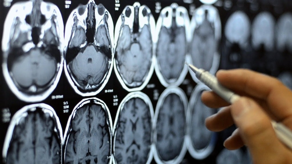 老人痴呆症又名失智症。路透社